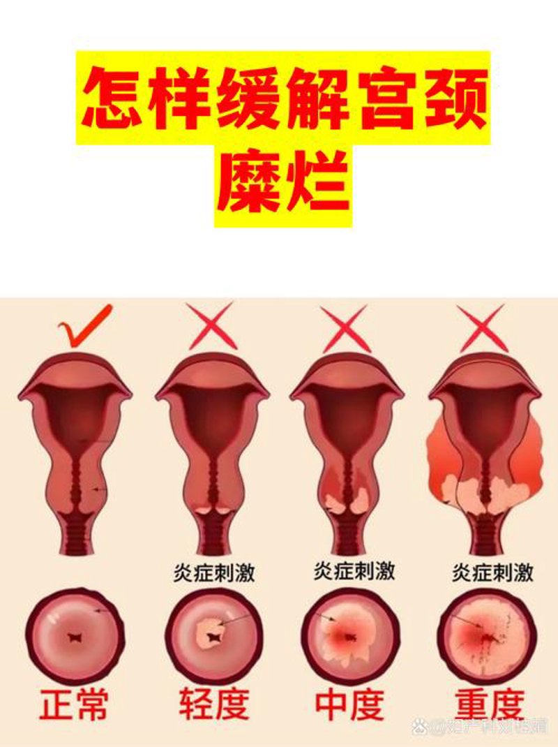 宫颈糜烂