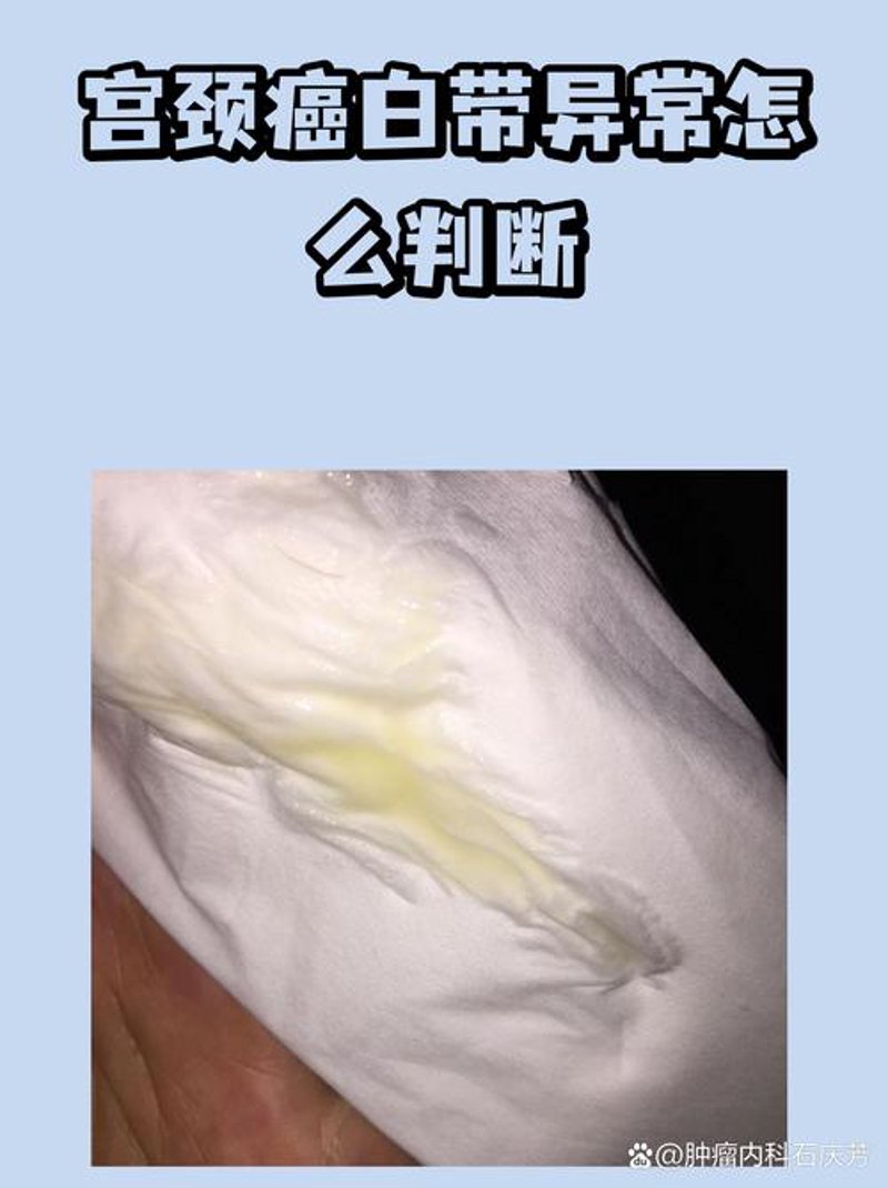 白带异常